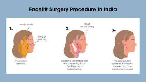 Facelift Surgery Procedure in India